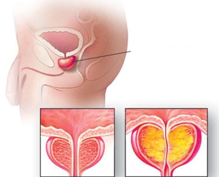 Location of the prostate gland, normal and enlarged prostate in chronic prostatitis. 