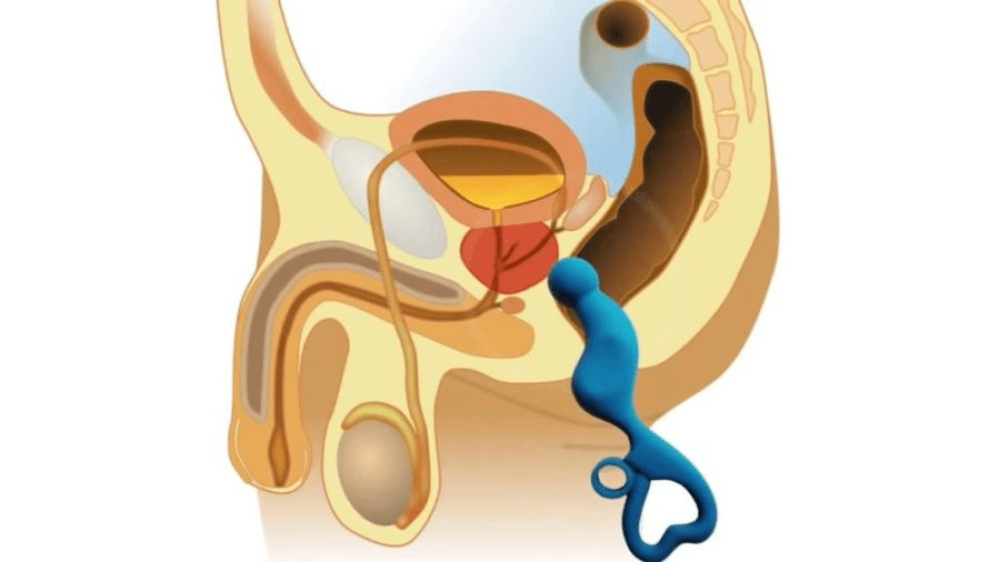 Prostate massage for the treatment of prostatitis.