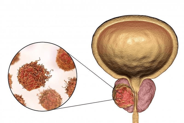 What does damage to the prostate look like