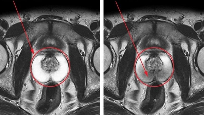 Healthy and inflamed prostate with chronic prostatitis.