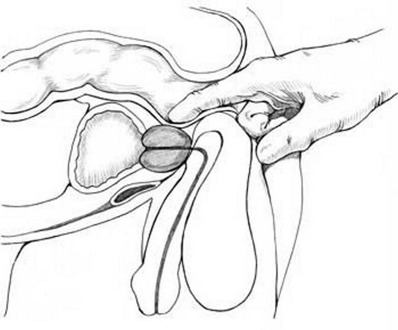 Prostate massage for chronic prostatitis.